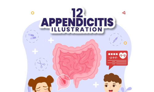 12 Appendicitis Inflammation Illustration